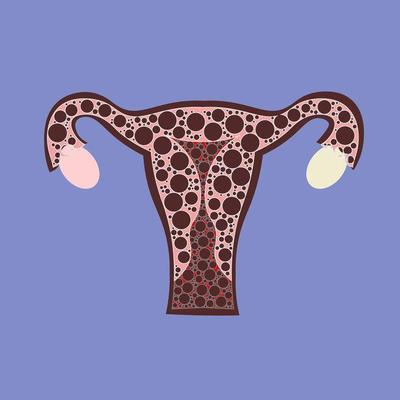如何明确诊断卵巢囊肿 诊断卵巢囊肿3个方法很重要