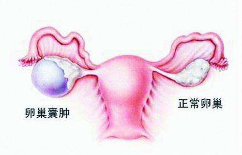 如何预防卵巢囊肿？做好这5点，绕着你走！